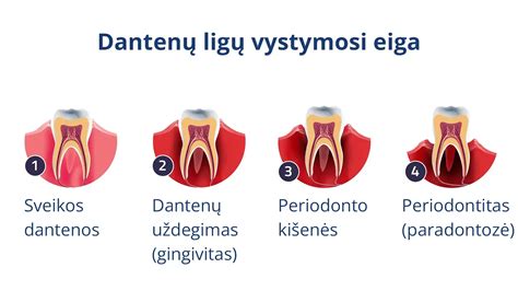 Infografika apie periodonto ligų etapus ir gydymą