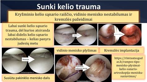 Infografika: kaulų lūžių tipai pagal klasifikaciją