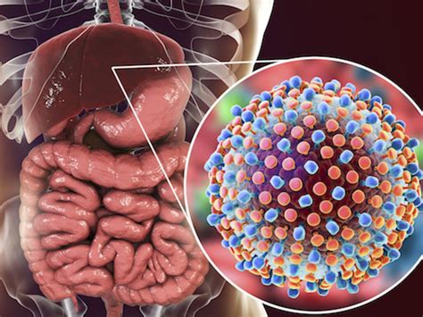 Medicininė iliustracija: kepenų paveikimas hepatitu