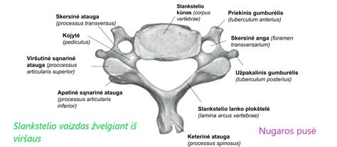 Schema, iliustruojanti nestabilius stuburo slankstelius