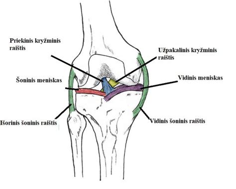 Schema, iliustruojanti kelio sąnario meniskus ir jų pažeidimus.