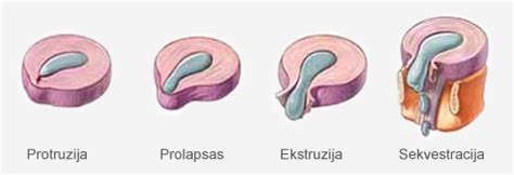 Infografika apie disko išvaržos vystymosi etapus